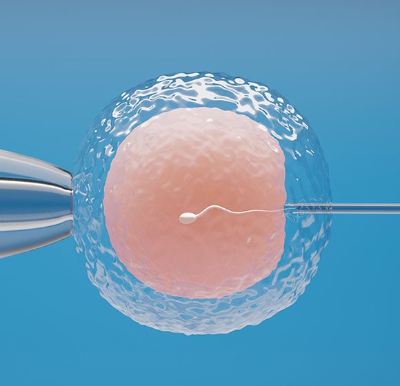ICSI Treatment